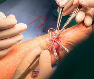 Vascular surgery